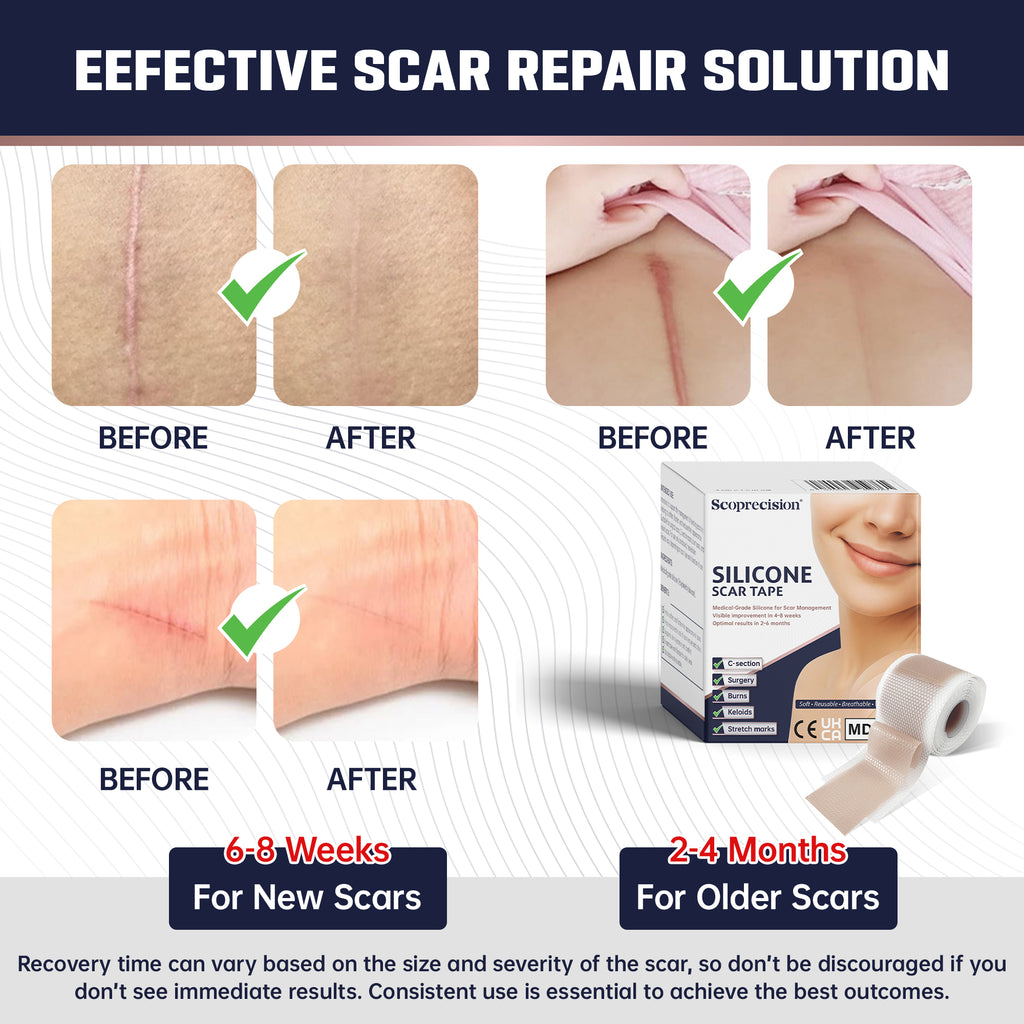 Silicone Scar Tape