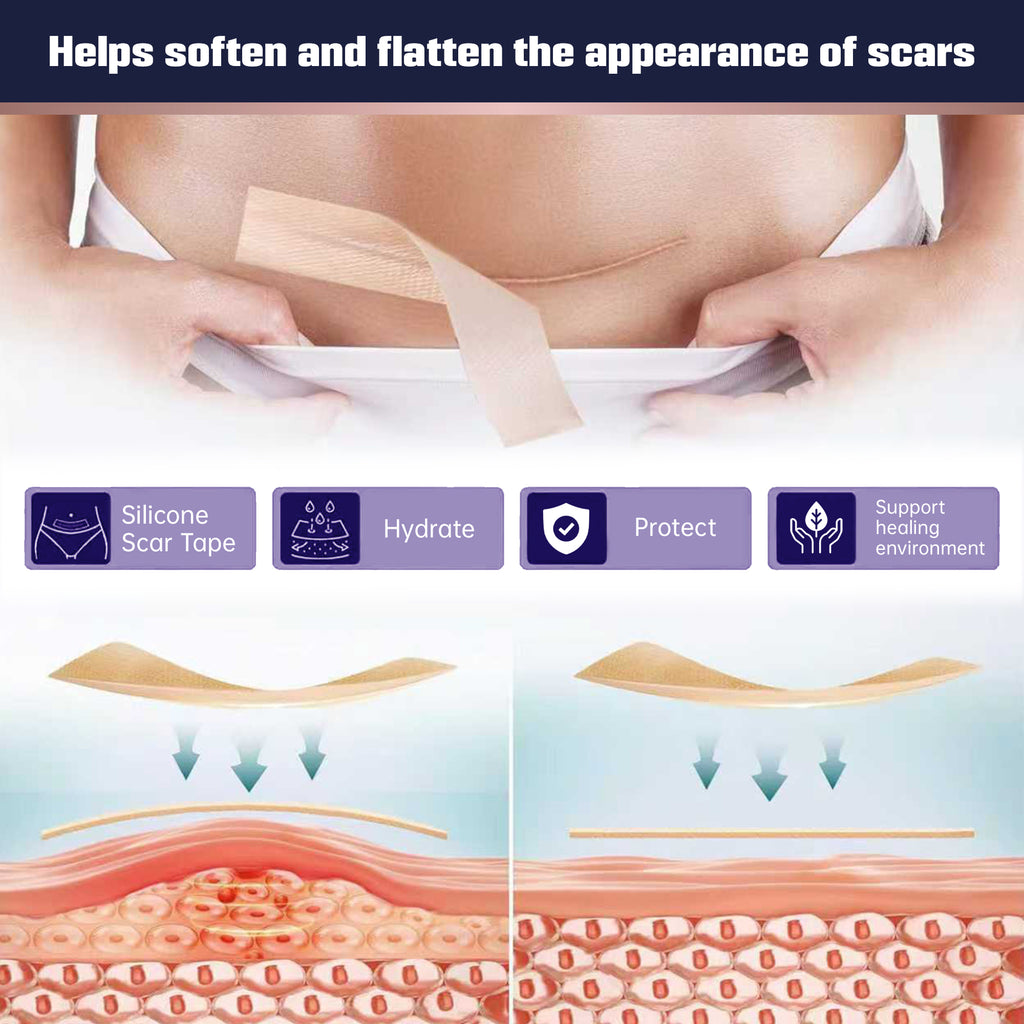 Silicone Scar Tape